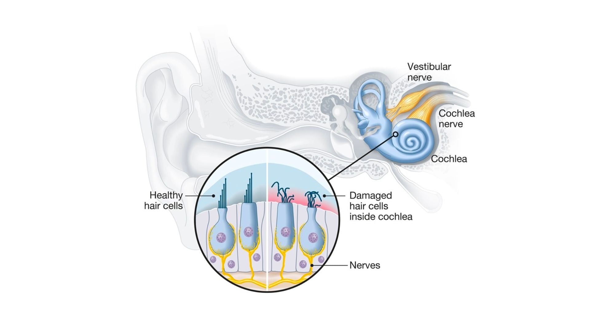 Understanding the Five Different Types of Hearing Loss